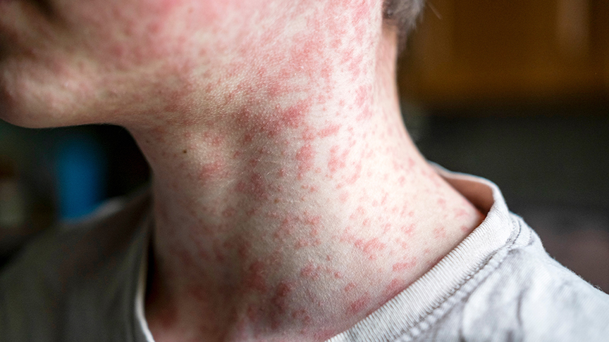 Persons neck with measles rash